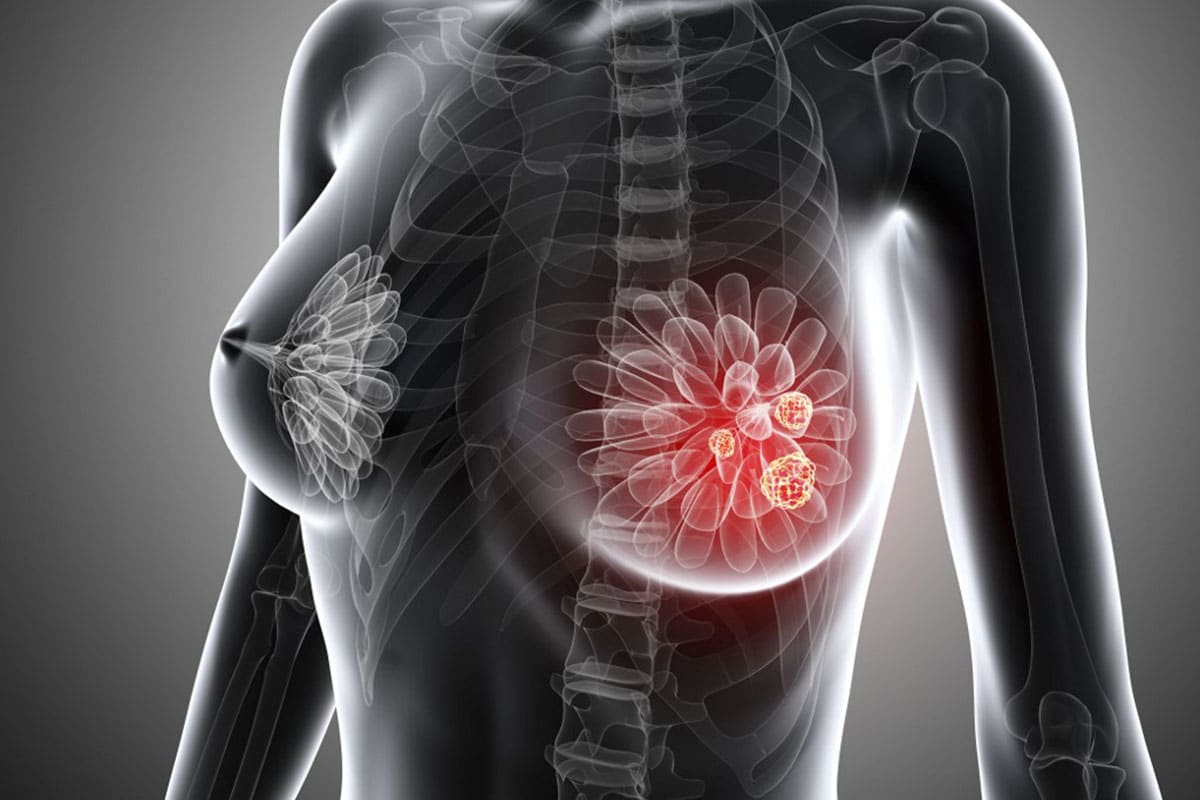 злокачественная опухоль в груди у женщин фото 92